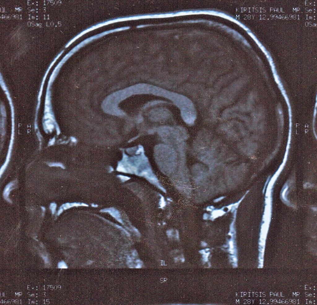 MRI showing brain (2010)